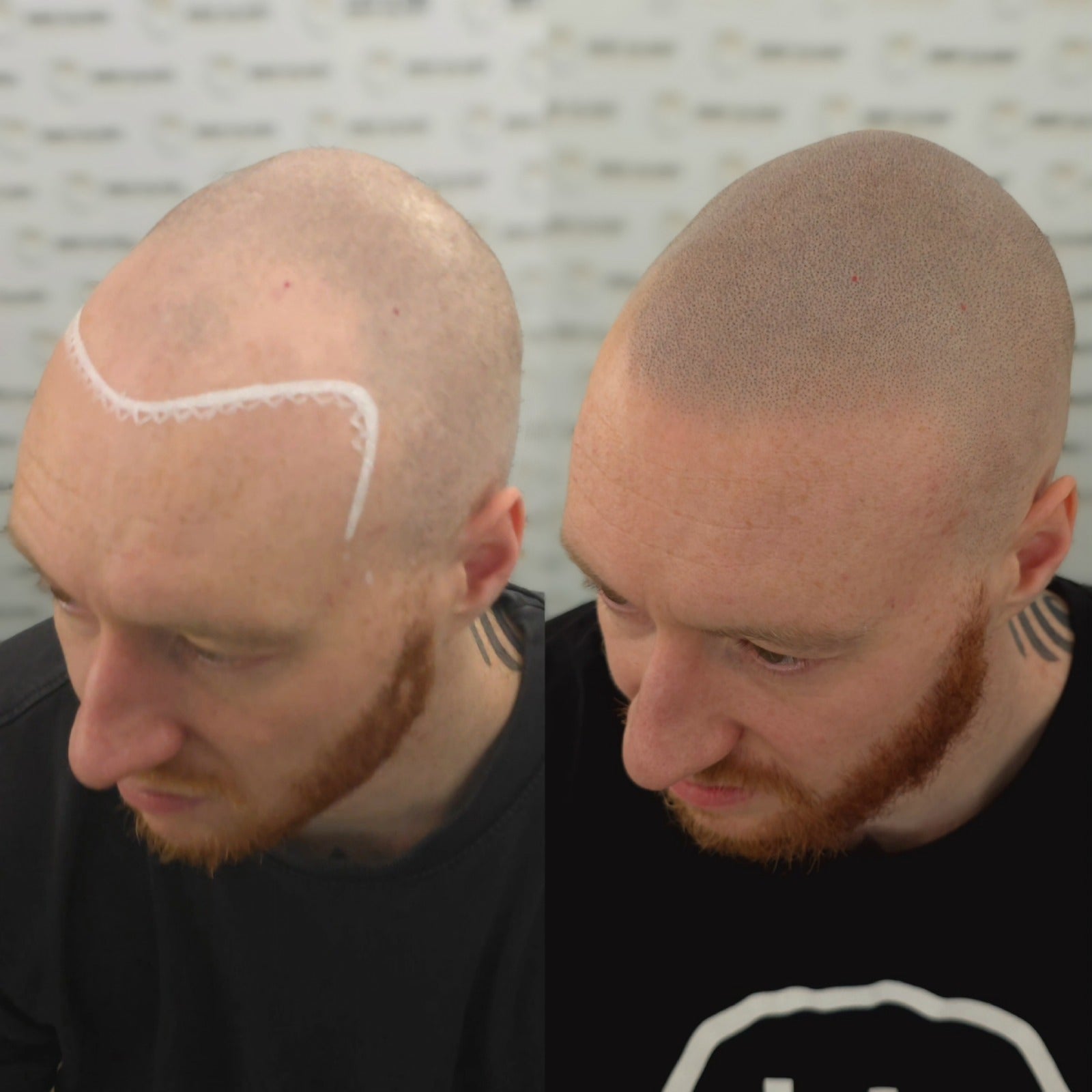 Hanafy Brown SMP - Folicule Brown Scalp Pigment for Trichopigmentation