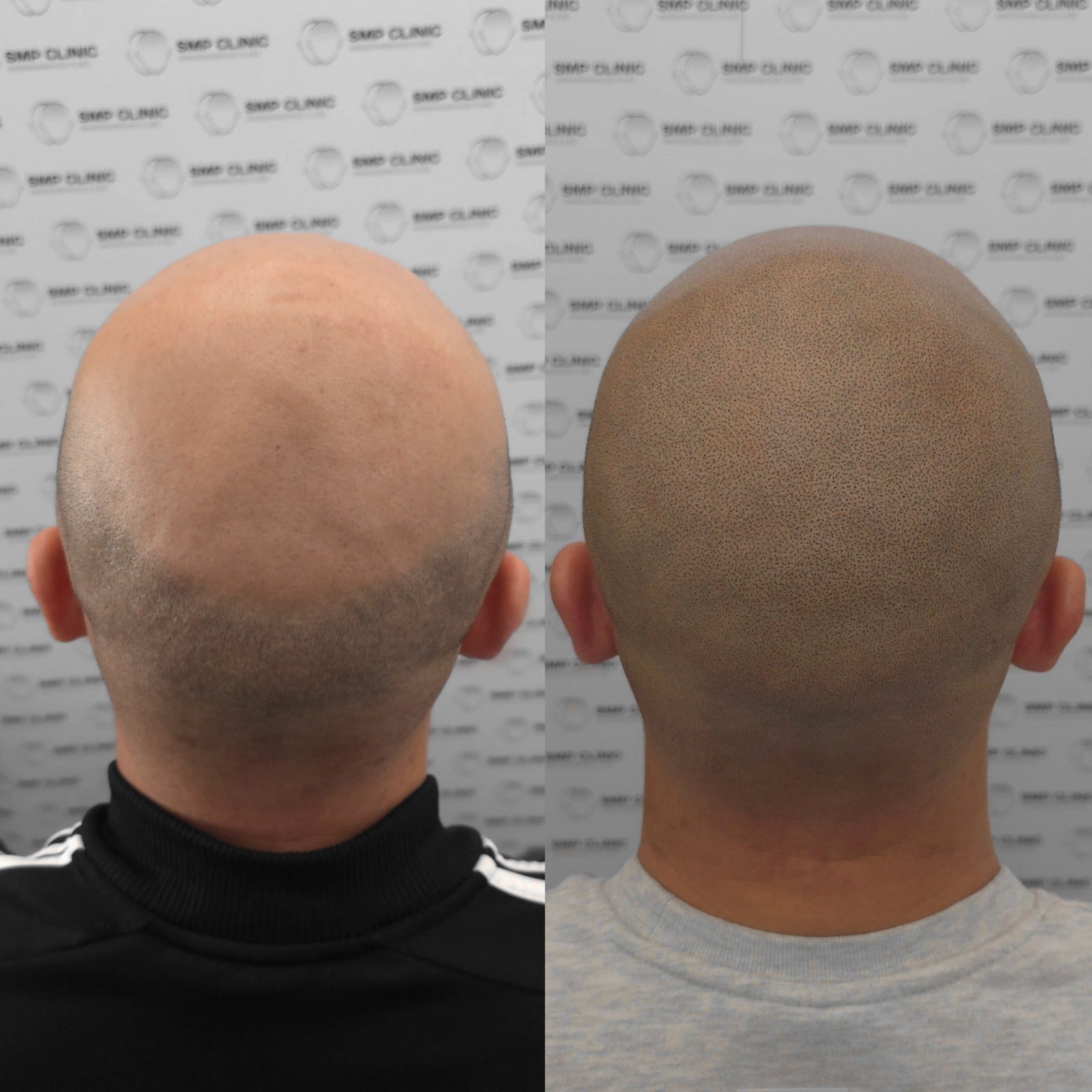 Hanafy Brown SMP - Folicule Brown Scalp Pigment for Trichopigmentation