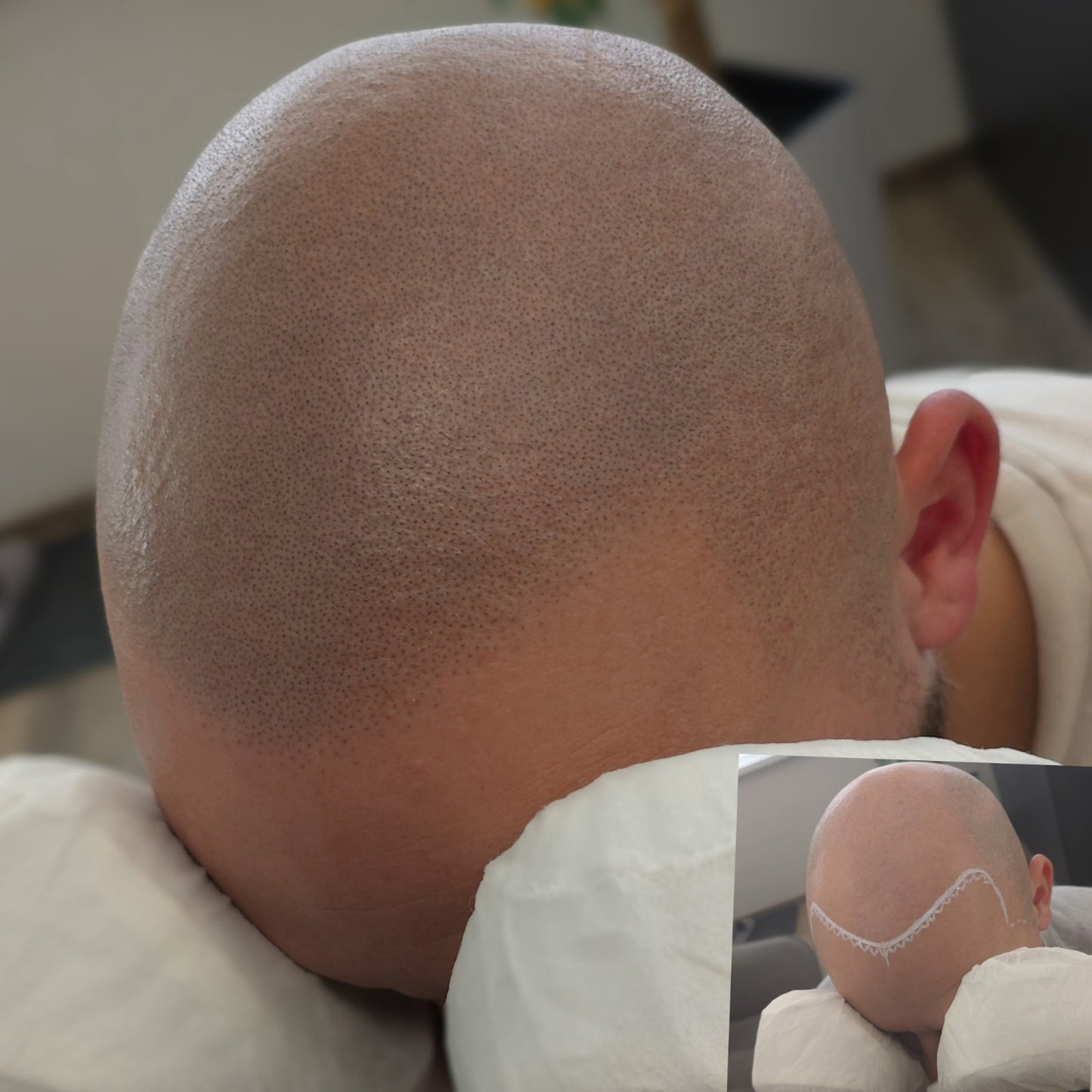 Hanafy BLACK SMP – Follicule Black Pigment voor Hoofdhuid Micropigmentatie (Trichopigmentatie)