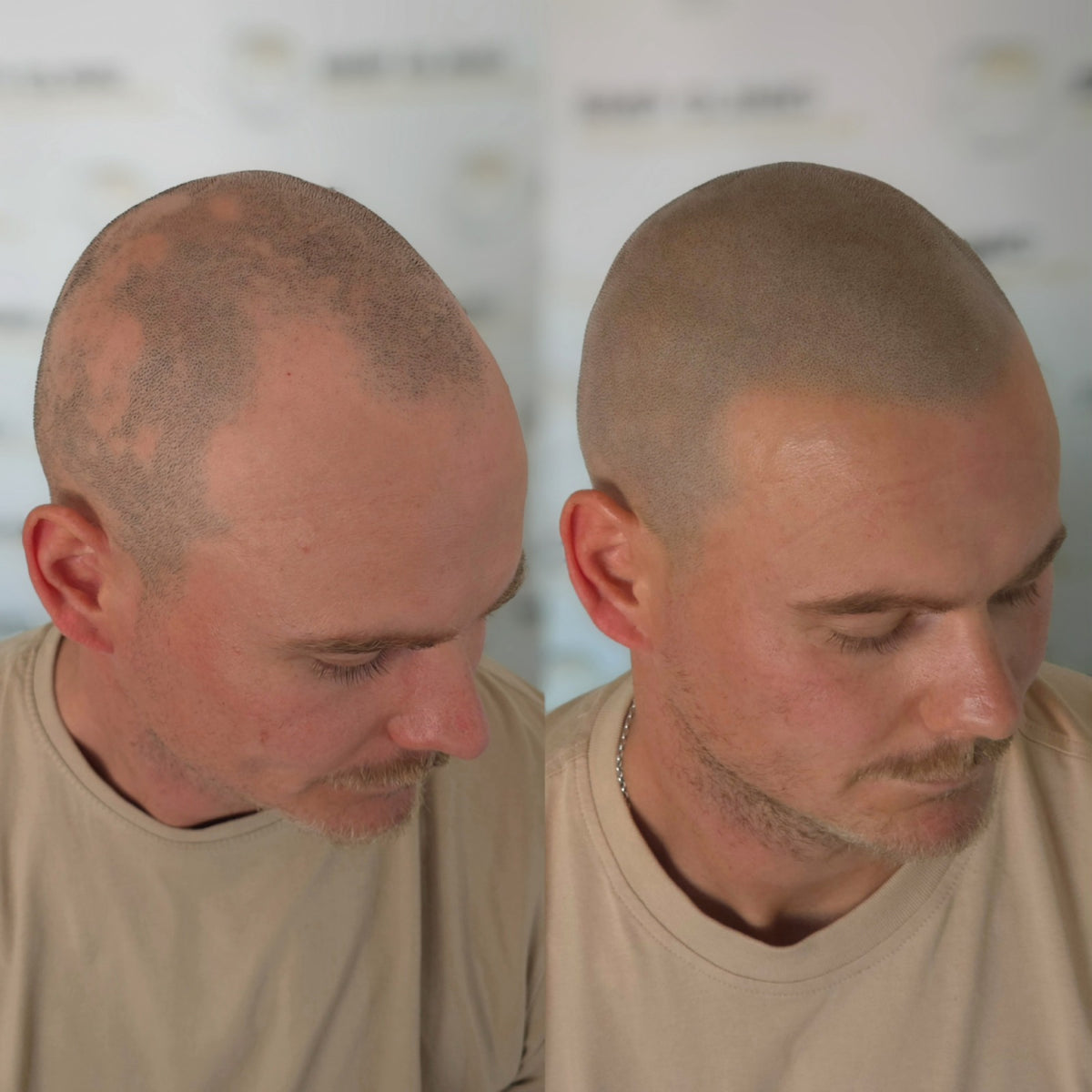 Hanafy Folicule scalp pigment for trichopigmentation, product details