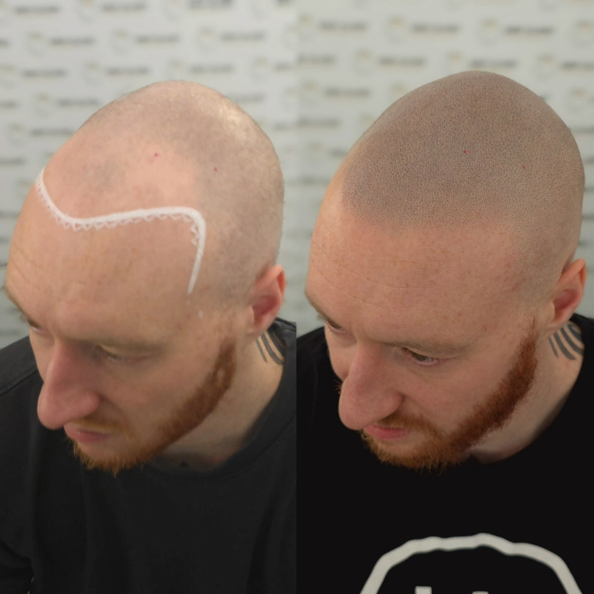 Hanafy Folicule SMP pigment range for scalp micropigmentation artists