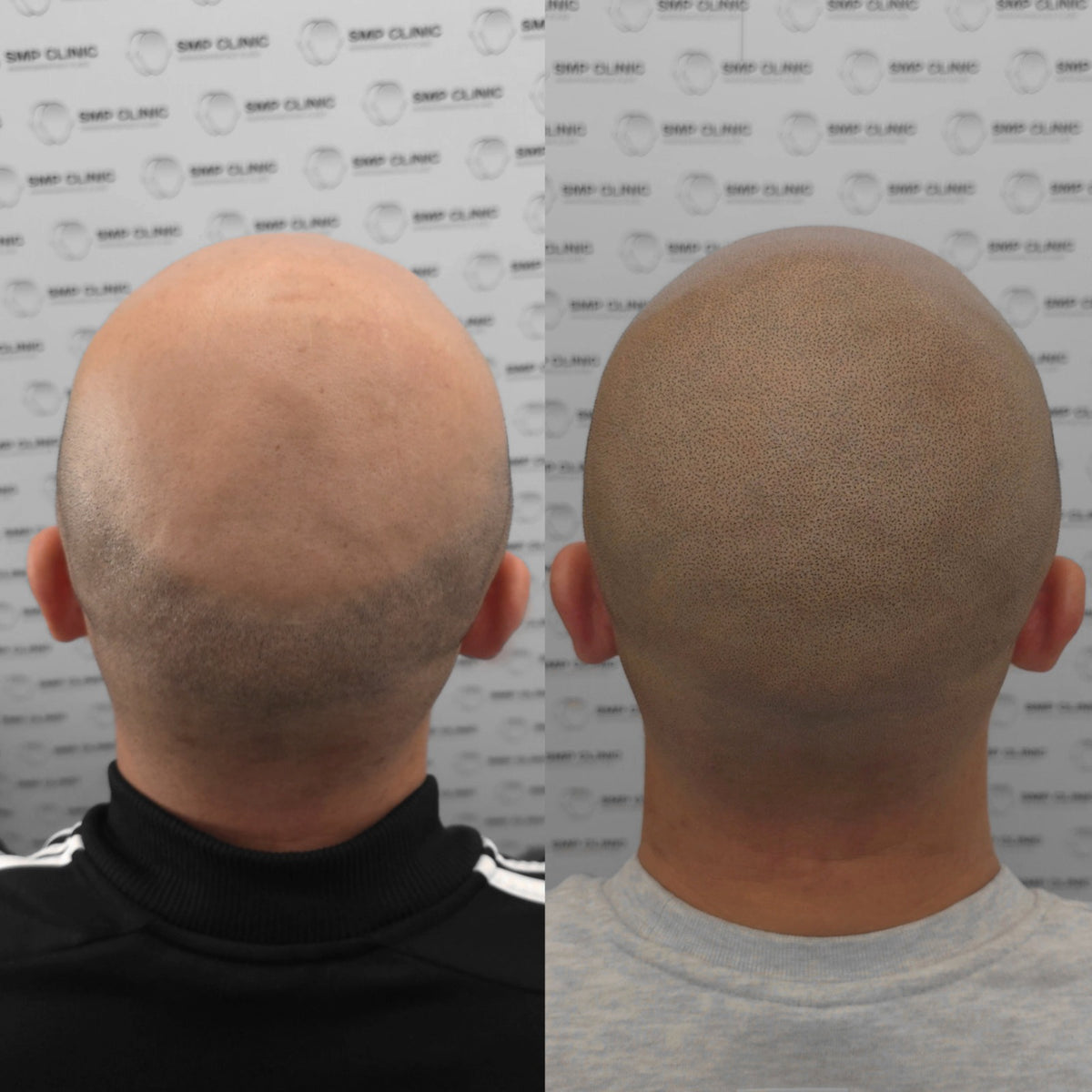 Hanafy Folicule pigments for scalp micropigmentation, information card