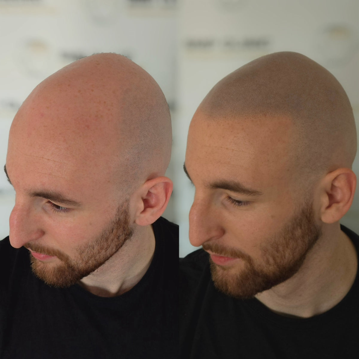 Hanafy Folicule trichopigmentation pigment, usage information