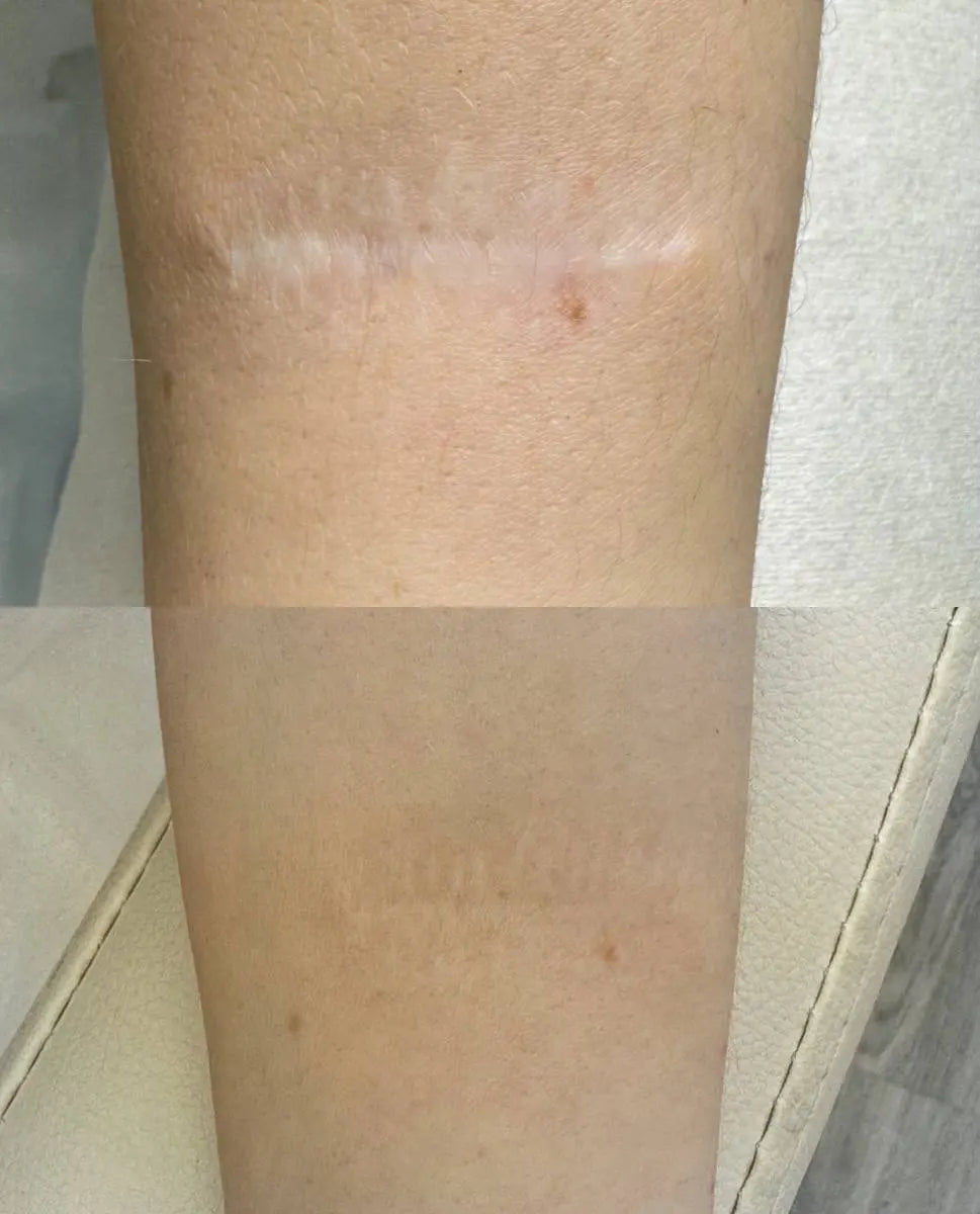 hanafy scar camouflage before after