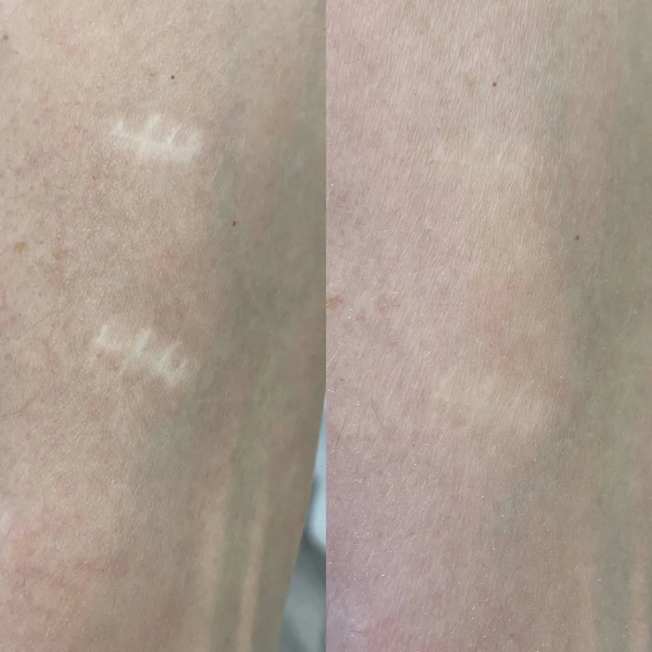 scars gone camouflage from hanafy 